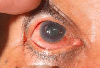 External eye photo example